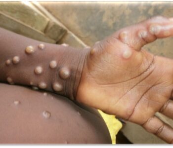Mpox cases